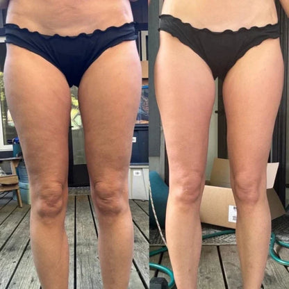 CelluSculpt™ - Anti-Cellulite Massager